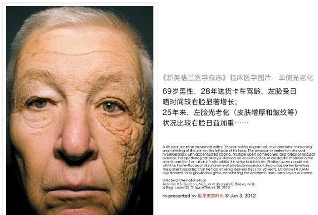 皮肤癌|为什么臀部比脸上的皮肤好？不起皱纹，也不长斑