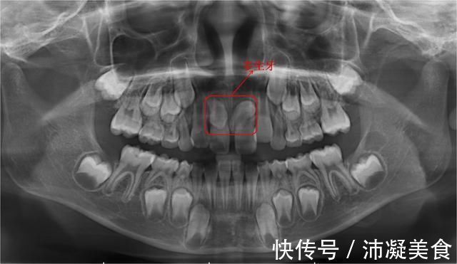 孩子|7岁孩子门牙掉了1年，一直长不出来，家长着急，该怎么办？