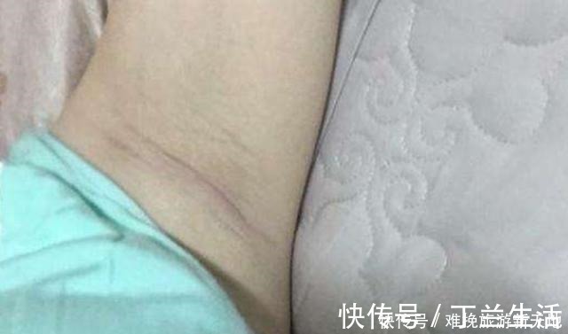 孕期|孕期这些部位黑到“怀疑人生”,孕妈别担心,这是娃发育好的表现