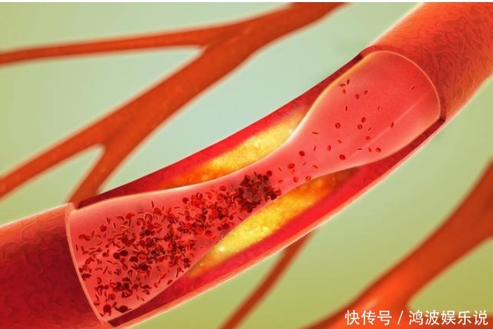 身上这4处疼痛,可能是血管堵了,做好3件事,保持血管畅通