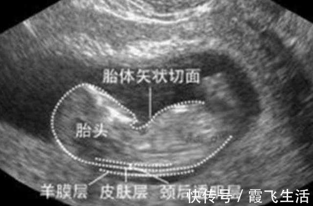 唐氏筛查|孕期这项检查,能率先查出畸形儿,产妇却崩溃比高考还难通过