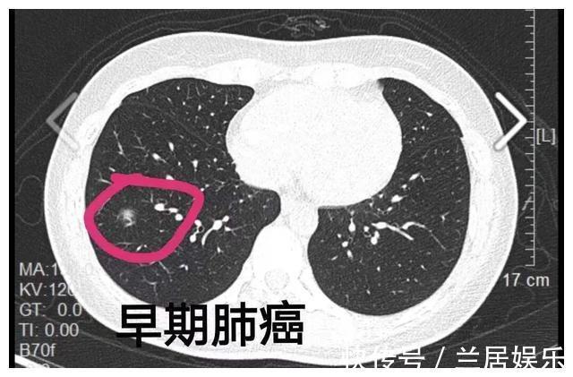 癌症|北大人民医院刘医生父亲查出了肺癌,希望放弃治疗,我没同意