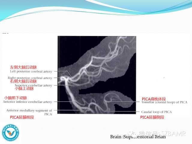 mr|椎-基底动脉系统解剖