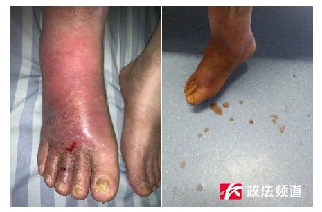 红肿|?长沙50岁男子足部红肿没重视，结果差点要截肢