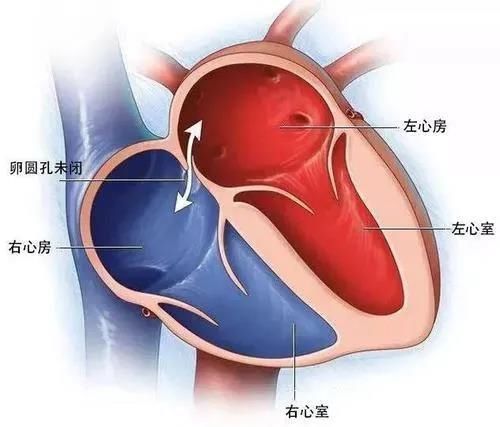 先天性心脏病|衡阳市中心医院完成首例单一胸壁超声引导下经皮介入PFO封堵术