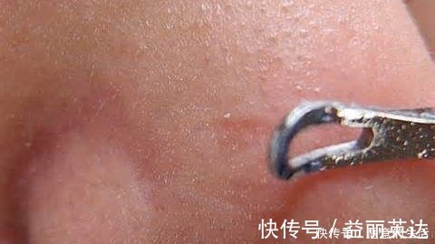 洗面奶|先别慌着挤黑头,这3种原因你知道了再挤也不迟!