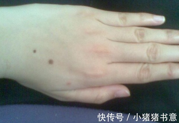 黑痣|手上若看见这个“玩意”或许是癌细胞苏醒的“前兆”最好别忽视