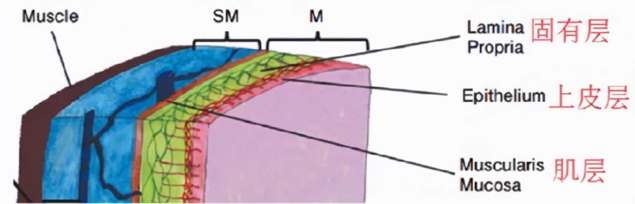 慢性咽喉炎|慢性咽炎就诊,却查出了食管癌,二者该如何分辨医生告诉你