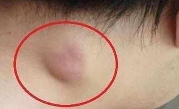 凝血功能|注意癌症早期,身体会出现3个症状,早看早预防