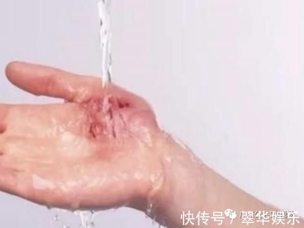 刘女士|女童掉进洗澡水被大面积烫伤，医生：牢记这5个字可救命