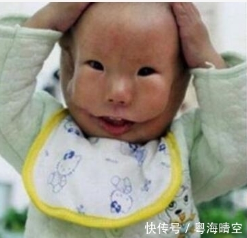 男婴|男婴出生时脸部畸形,多次孕检未检验出,专家给出这样的解释