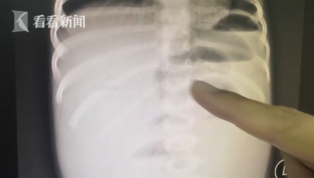 肠梗阻|1岁女童误把网红玩具当糖吞下 医生紧急手术取出