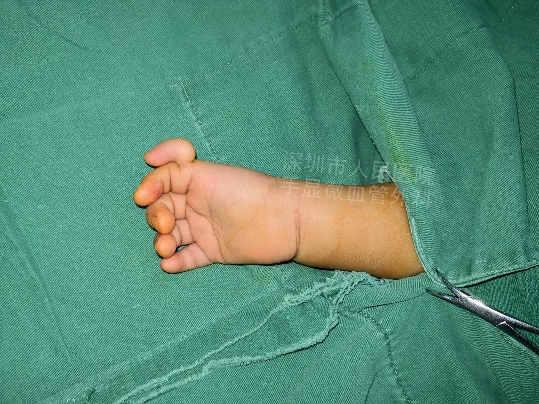 发育不良|得了这病,12岁男孩手指比香蕉还粗!7种常见的手部畸形,家长们要注意