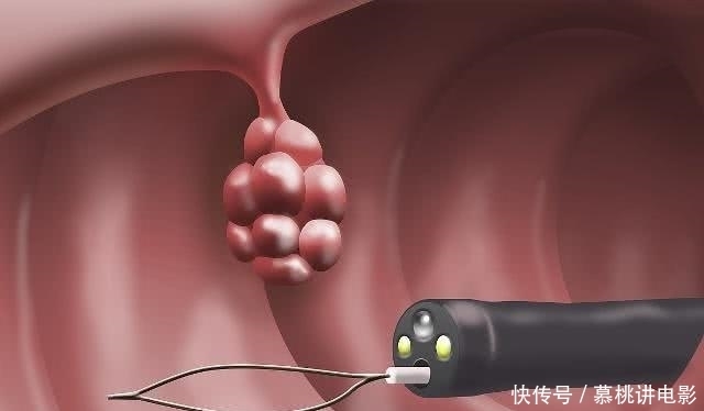 好坏|息肉有好坏之分,这2个部位出现息肉,赶紧上医院吧!