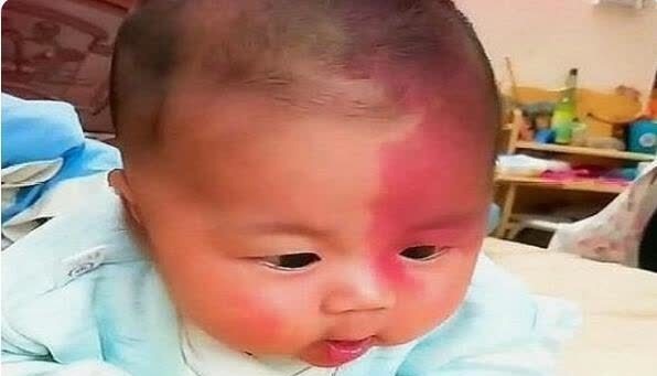 宝宝|宝宝的胎记怎么来的?产科医生:孕期这2种行为易长胎记,要避开