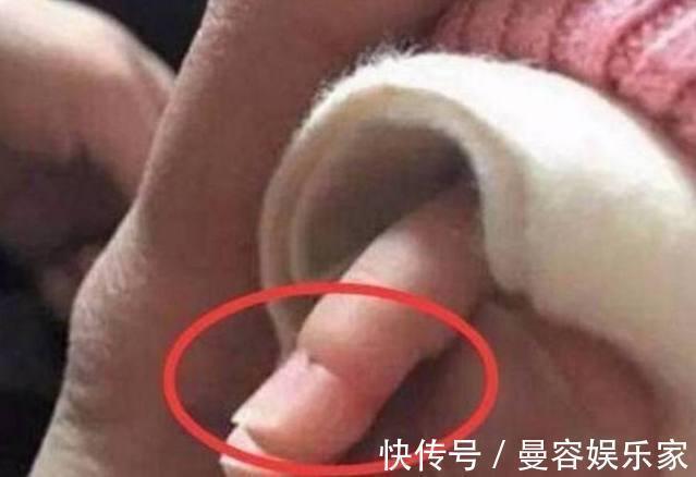 纤维带|宝妈发现孩子身上长一圈圈的,都不知道是啥,医生检查后泣不成声