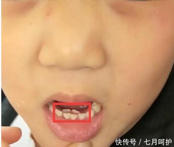 每个孩子|6岁孩子长出双排牙,赶紧带去医院检查,得知原因宝妈后悔不已