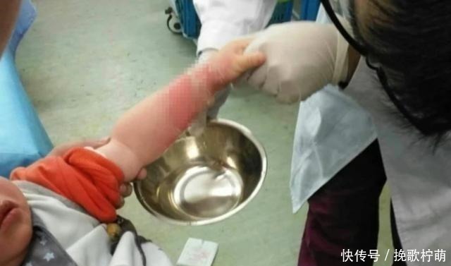 烫伤处|4岁娃被开水烫伤,宝妈“两个果断”救了娃,医生称赞没少读书!