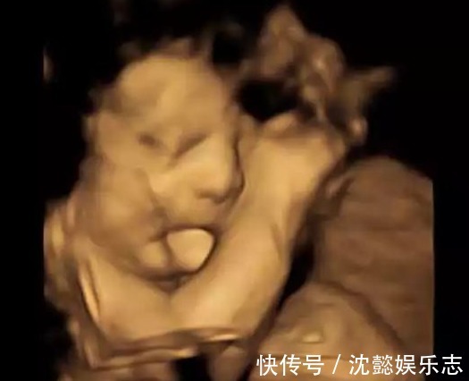 巨舌|在B超检查时,妈妈看到孩子扮鬼脸还觉得可爱,出生后却吓一跳