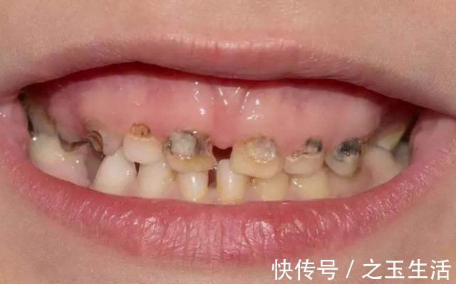 乳牙|让孩子“满嘴烂牙”的不是糖,而是“这1物”,每个人家里都有