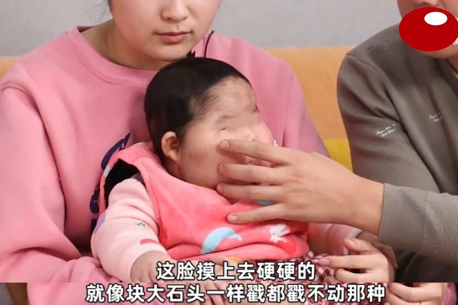 抑菌|“大头娃娃”再现,抑菌霜激素超标,致5个月女婴疯狂长胖长毛