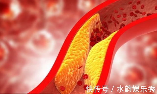 胆固醇|胆固醇高的人,医生:若想稳定血脂,这3类食物,建议少吃或不吃