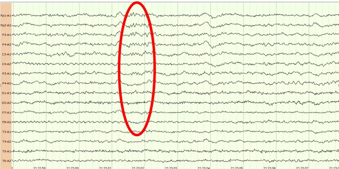 心跳骤停|医生,我爸还能醒吗?会不会变成植物人?