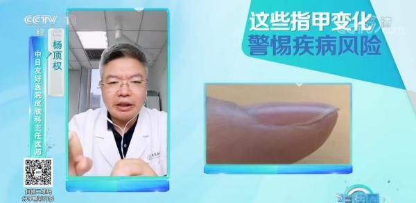 杵状甲|请低头:长这几种指甲的人注意了