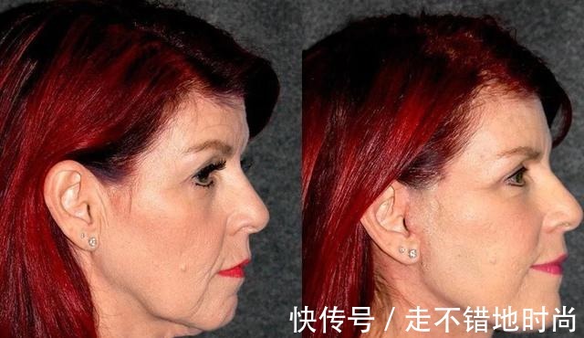 拉皮 拉皮手术“落伍”了,早都“过时”了!