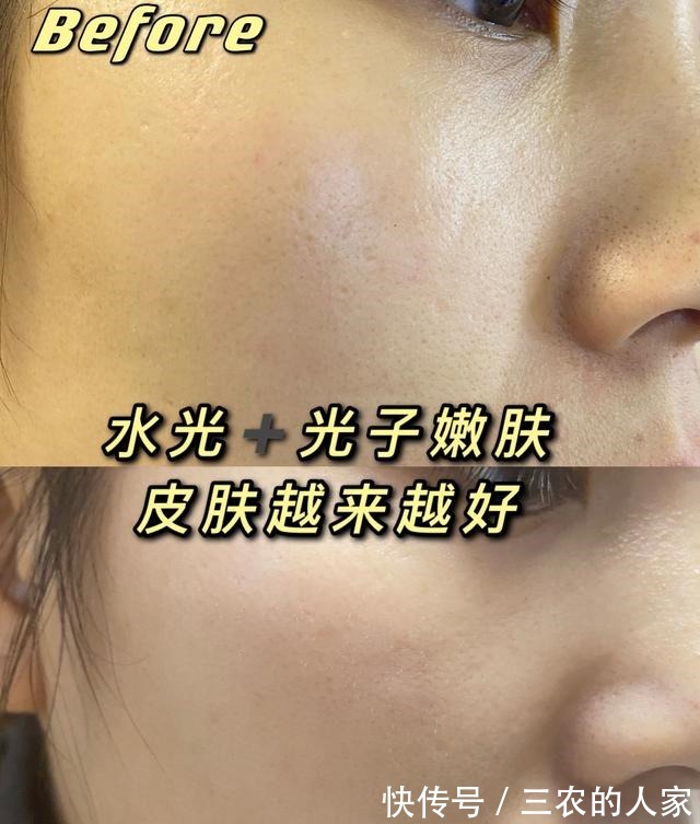 光子 缩毛孔水光针光子嫩肤双管齐下!缩毛孔水光针光子嫩肤双管齐下!