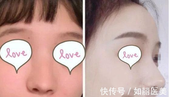 软骨 蒜头鼻光靠鼻头鼻翼缩小手术效果不明显!需做鼻综合来改善