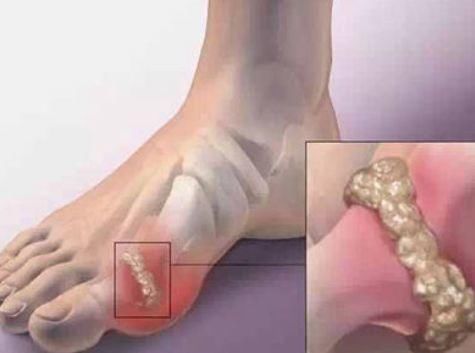 克星|以下2种食物是痛风的“克星”,常吃比痛风药都管用!早知早受益