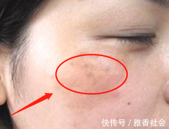 血脂升高|血脂高不高，看脸就知道脸上如果有4个表现，可能要降血脂了