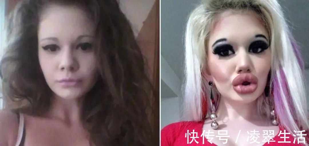 sofia 21次丰唇手术之后，这个妹子的嘴唇现在长这样…