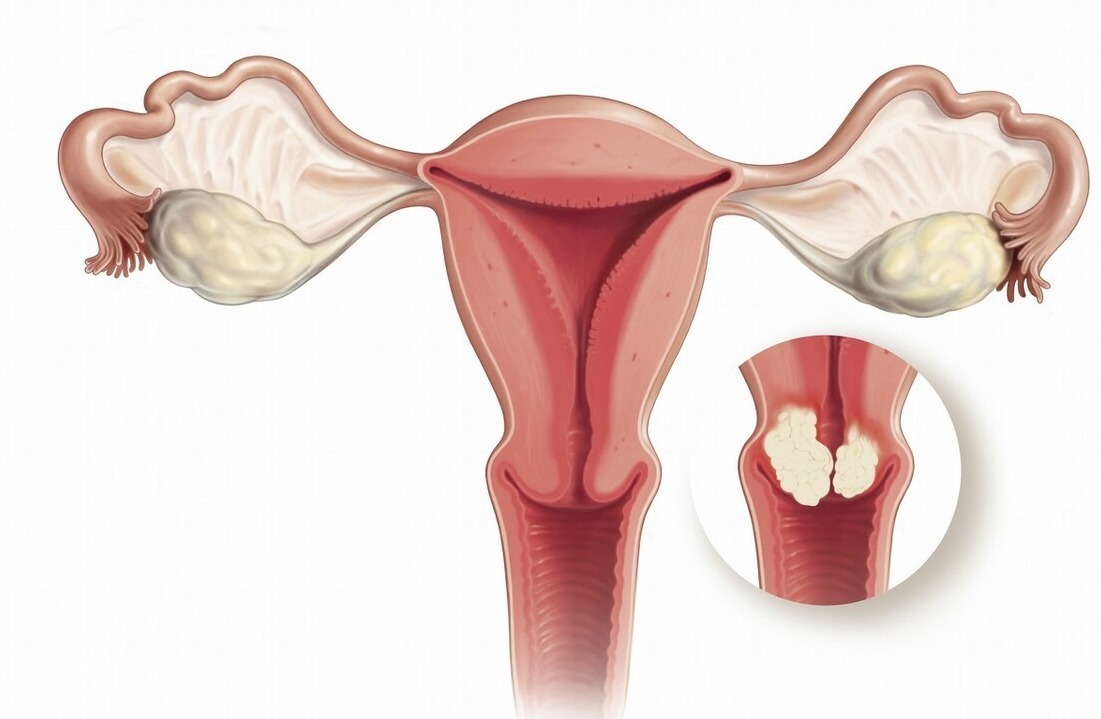 囊肿|身体有4个变化，八成是宫颈有囊肿，做好3件事，囊肿会消失