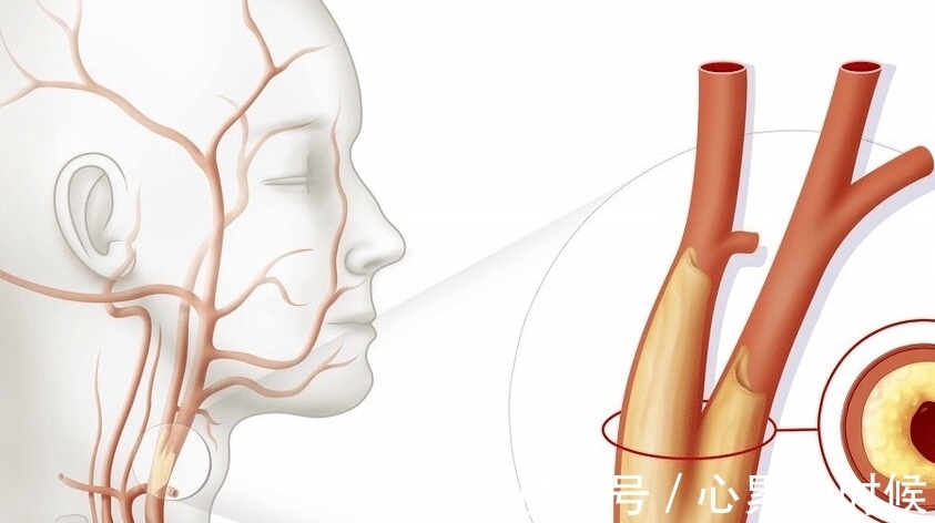 颈动脉狭窄|人到中年,不想中风,做好以下6点,让你活得更健康