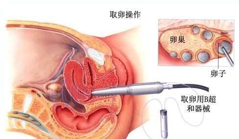 孩子|女人做试管婴儿都要经历些什么，看到最后，丈夫们应该羞愧