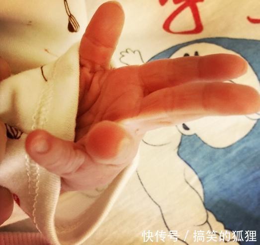 积食|宝宝2个地方“变化”，说明严重积食了，冬季带娃，谨记3多2少