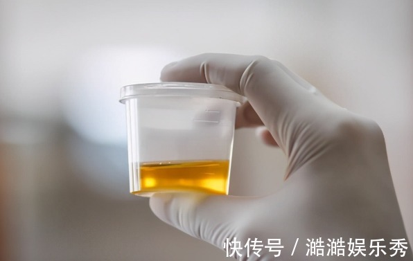 尿液|上厕所后,出现3种情况,说明你的血糖高了!糖尿病患者要注意