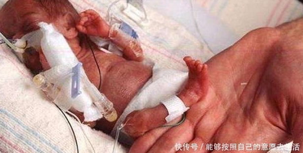 女婴出生只有25厘米,打破吉尼斯纪录,她