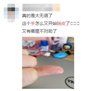 掌跖脓疱病|宝，听说你最近在脱皮？脱什么皮？