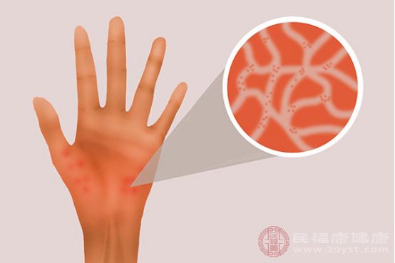 身上很痒一抓长蚊子包