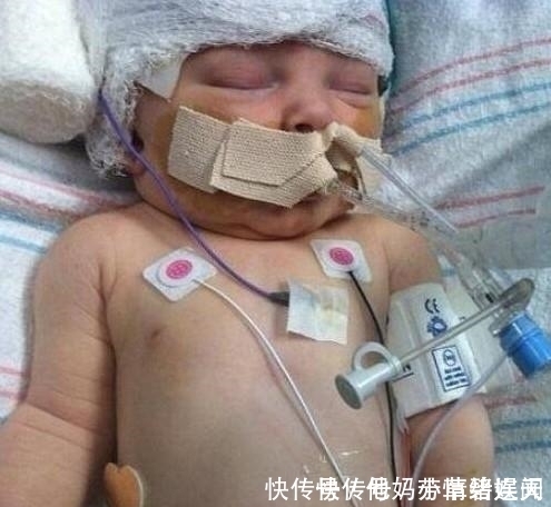 颅骨|德国妈妈坚持顺产不想留疤,宝宝出生后颅骨骨折5天后夭折