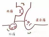 便秘|产后,十个妈妈九个“痔”?没想到最有效的“防痔”方法竟是这五招…