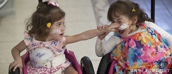 手术|3岁连体姐妹,成功做了人体分离手术,可惜术后每人只有一条腿