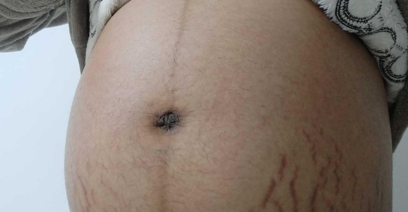 怀孕|怀孕7个月的孕妈每天抹油,但还是长了妊娠纹,医生的一句话扎心了