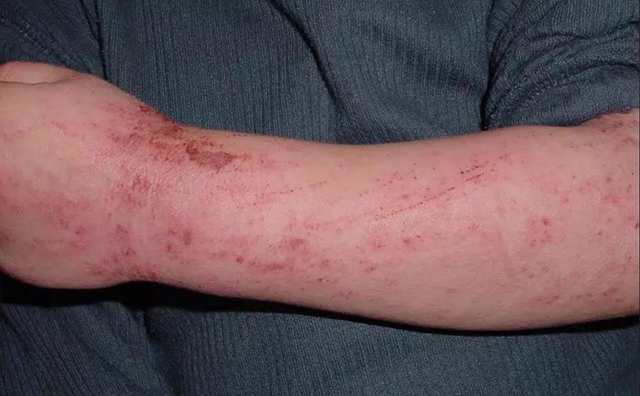 宝宝|宝宝患有特应性皮炎，家长日常如何防护？