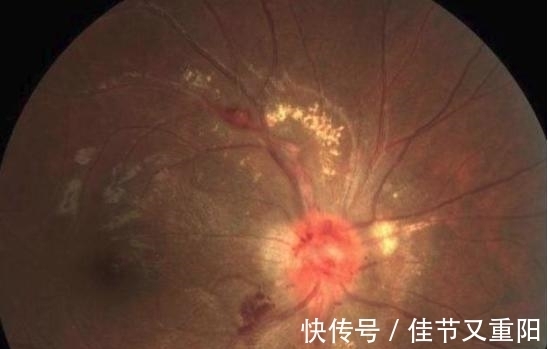 视网膜|有高血压却不管不顾,5大并发症悄然腐蚀你的身体!有症状就迟了