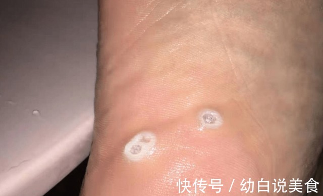 宫颈癌|21岁女子查出宫颈癌,医生皮肤3个异常,或不是过敏,建议了解