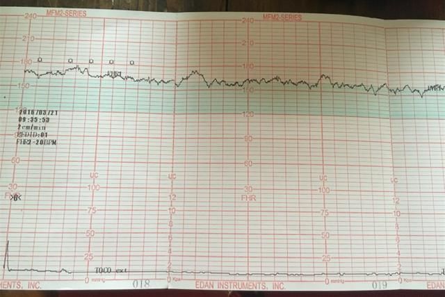 胎心|进行胎心监护，一会儿合格，一会儿不合格，是胎儿“缺氧”吗？